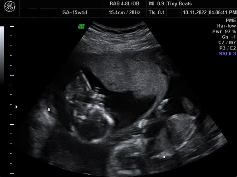 Understanding the Experience of a Twin Ultrasound Session