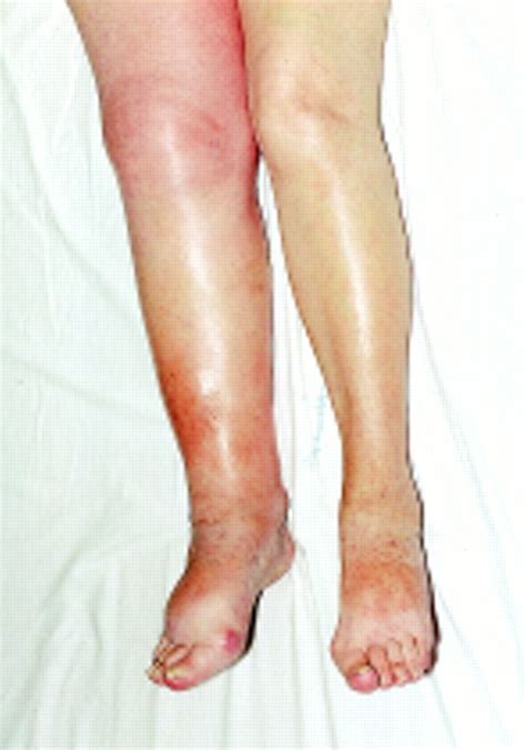 Understanding the Indications of Enlarged Lower Limbs