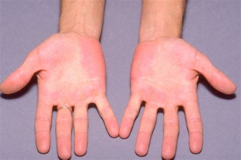 Understanding the Influence of Physical Factors on Erythromelalgia in Nighttime Visions