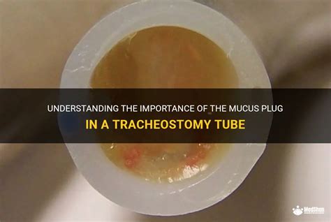 Understanding the Mucus Plug