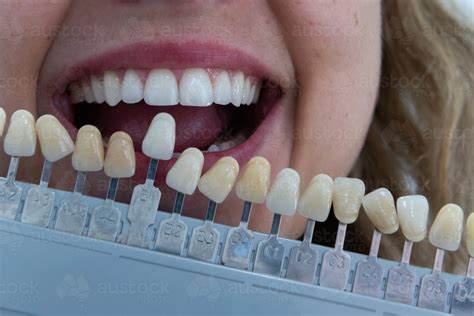 Understanding the Natural Shade of Teeth