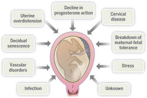 Understanding the Onset of Premature Delivery throughout Gestation