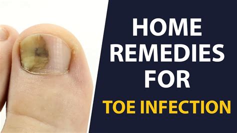 Understanding the Origins and Remedies for a Toe Infection