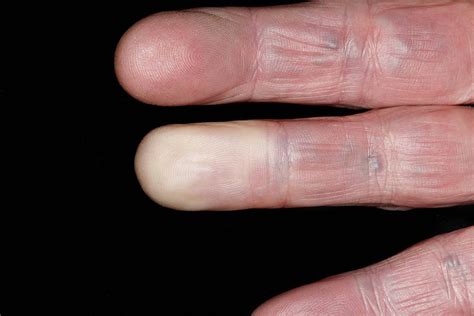 Understanding the Phenomenon of Unintended Parting of Nails in Reveries