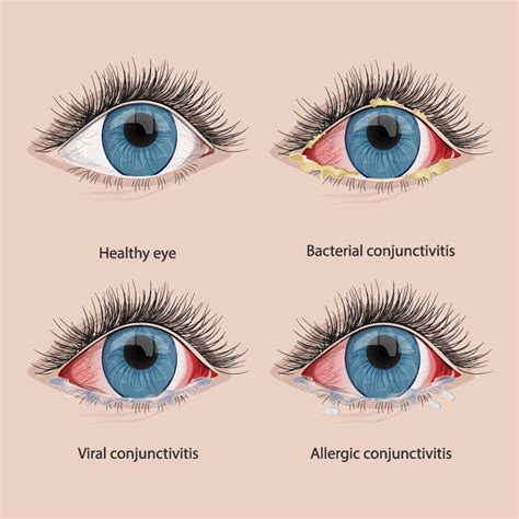 Understanding the Presence of Ocular Secretions in Dream Reflections