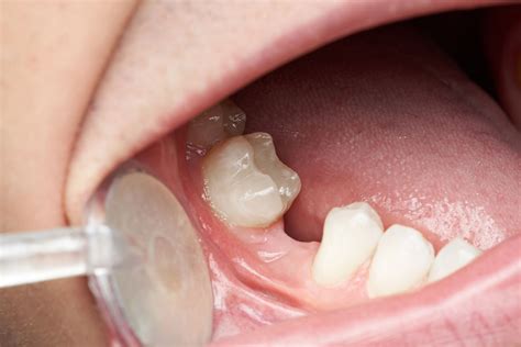 Understanding the Reasons behind the Dislodgement of Dental Fillings