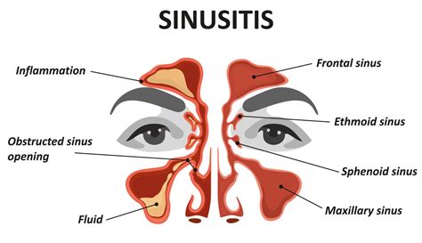 Understanding the Science Behind Nose Extraction Dreams