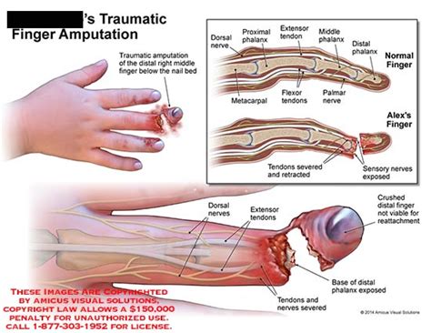 Understanding the Significance of Dreams Involving Finger Amputation and its Impact on Reality