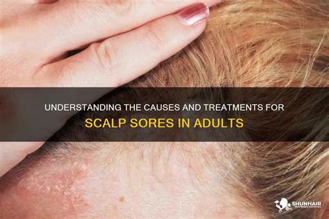 Understanding the Significance of Sores on the Scalp: Their Origins, Meanings, and Effective Solutions