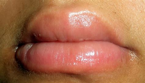 Understanding the Swelling: An In-depth Look into Swollen Lower Lips