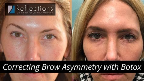 Unintentional Consequences: How Beauty Treatments Can Lead to Uneven Brow Alignment