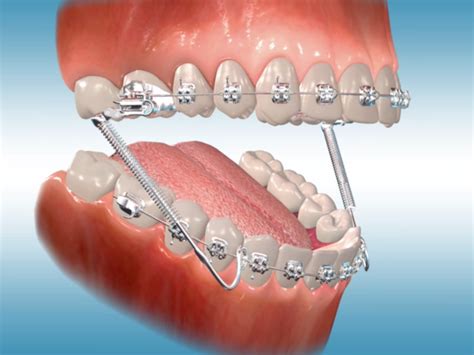 Unlocking the Symbolic Meaning Behind Damaged Orthodontic Appliances in the Realm of Dream Analysis