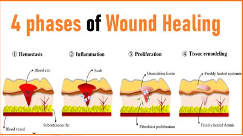 Unraveling the Intricate Process of Wound Recovery