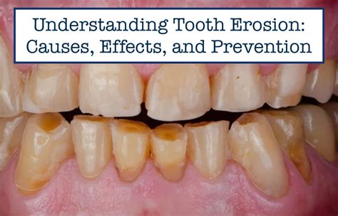 Unraveling the Mysteries: Understanding the Origins of Tooth Erosion in Dreams