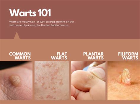 Unraveling the Mysterious Significance of Warts on Various Body Areas