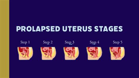 Unraveling the Possible Causes of the Prolapse of the Uterus