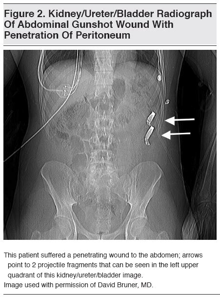 Unraveling the Psychological Roots Behind Visions of Abdominal Gunshot Wounds