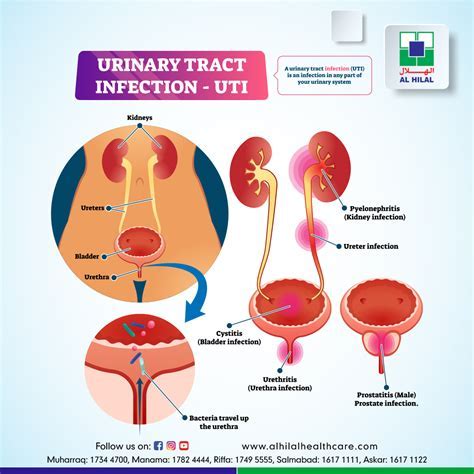 Unraveling the Significance of Urinary Tract Infection-related Foresights