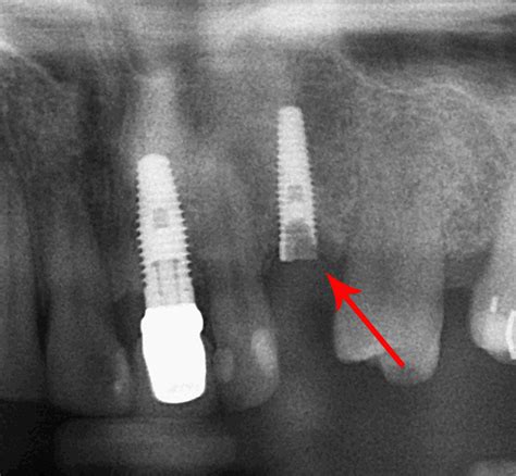 Unresolved Fears and Anxieties: How Fractured Denture Implants Mirror Inner Distress