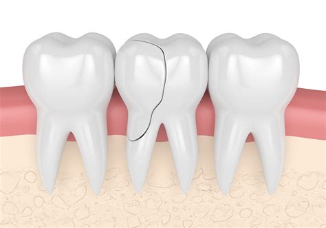 Unresolved Issues and Cracked Molar Dreams: How They Are Connected