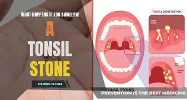 Unveiling the Origins and Manifestations of Tonsil Stone Incidents