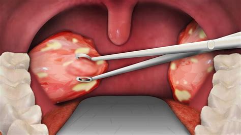 Unveiling the Procedure of Tonsil Extraction: Insight into its Execution and Purpose