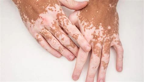 Unveiling the Secrets: Vitiligo and Other Skin Conditions