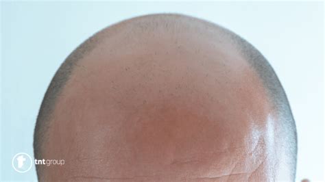 Unveiling the Significance: Delving into the Meaning behind Dreams of Balding