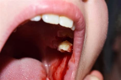 Unveiling the Symbolism: Decoding the Significance of Blisters on the Mouth