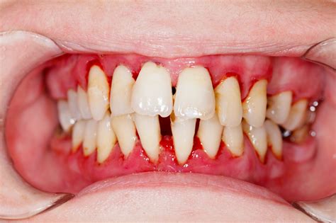 Unveiling the Telltale Signs of Gum Inflammation