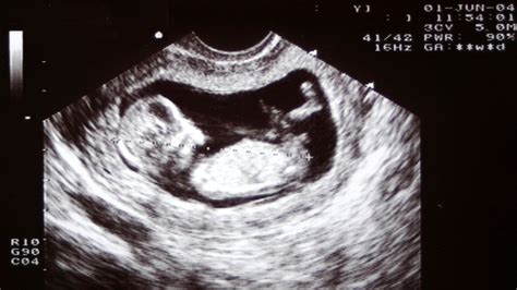 Unveiling the Tiny Life: What Happens During a Baby Scan?