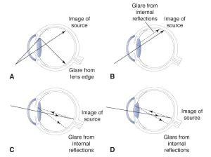 Unveiling the Triggers and Origins of Dreams Associated with Vision Disturbances