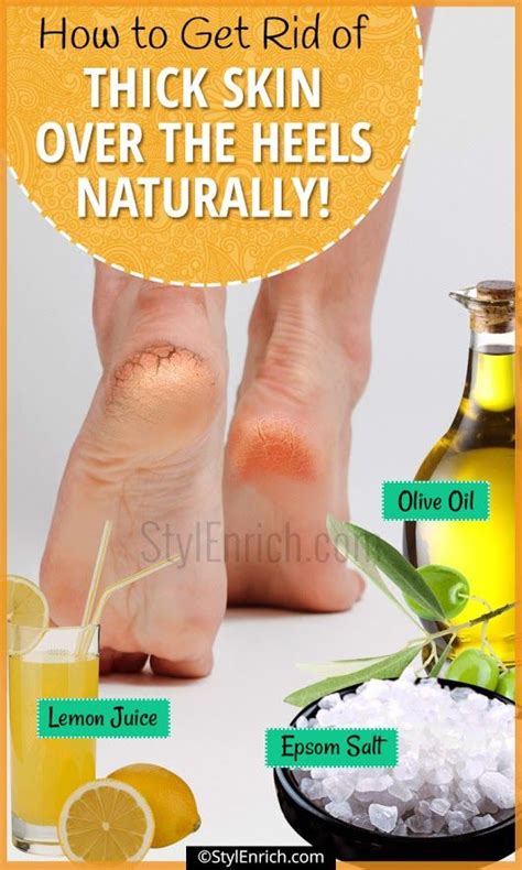 Utilizing Natural Remedies to Eliminate Exfoliation on Feet