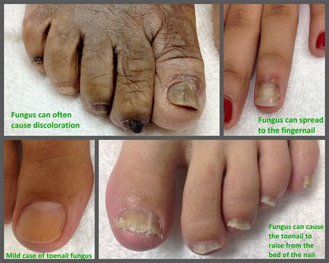 Various Scenarios Involving the Detachment of the Major Toenail 