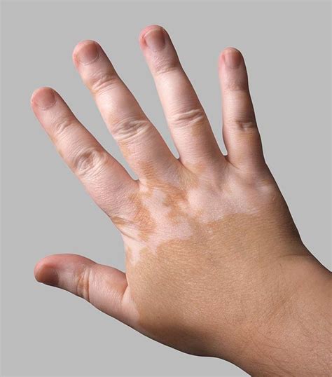 Vitiligo: An Often Encountered Source of Pale Patches on the Facial Skin