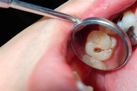 What Dreams of a Decayed Tooth Could Reveal About Your Physical Well-being