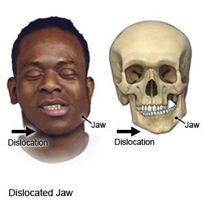 When the Act of Eating Becomes a Daily Struggle: The Impact of Jaw Dislocation on Everyday Life