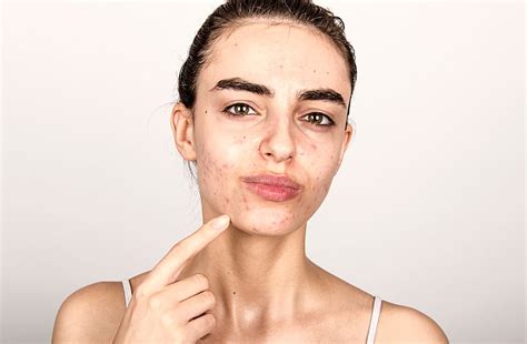 When to Seek Professional Help for Acne