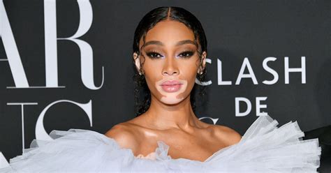 Winnie Harlow's Net Worth and Earnings