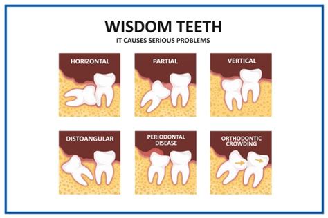 Wisdom Teeth Extraction: Indications and Considerations